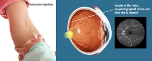 fluorescein-angiogram