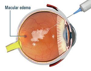 kenalog eye injection