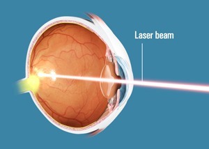 argon laser eye