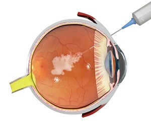 lmacular-degeneration-treatment