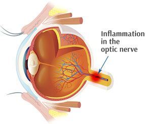 optic_neuritis