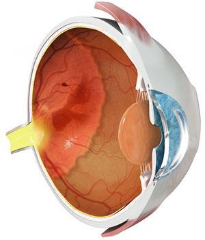 retinopathy of prematurity