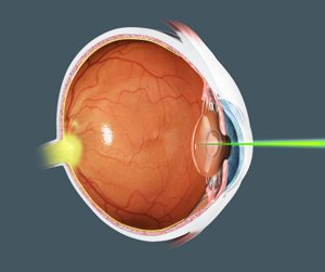 ysecondary_cataract