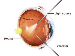 vitrectomy